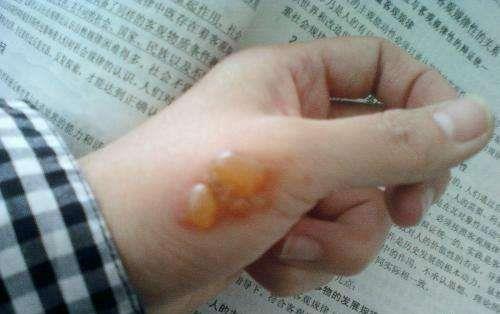 手被烫伤起泡怎么办?烫伤起泡怎么处理?烫伤的急救处理方法