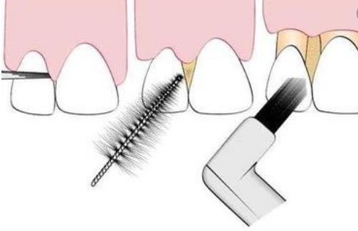 让你没有一点点防备的牙龈出血 用这三种方法止住它