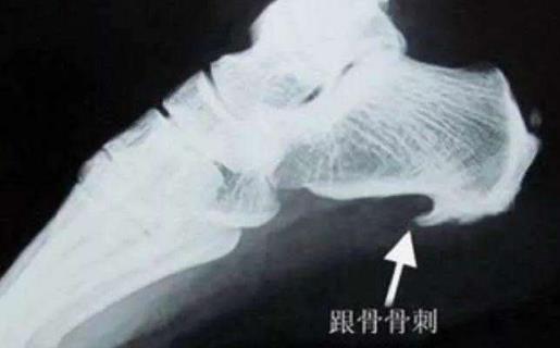 骨刺容易出现在这4个部位 骨刺患者不要随便做