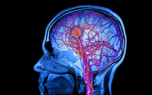 早上起床时出现剧烈的头痛 很遗憾脑出血可能找